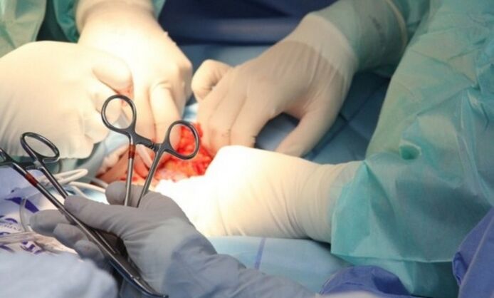 Ligamentotomia – cirurgia para aumentar o pênis