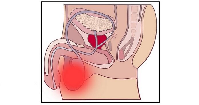 Uma complicação da cirurgia de aumento do pênis pode ser a inflamação dos testículos. 