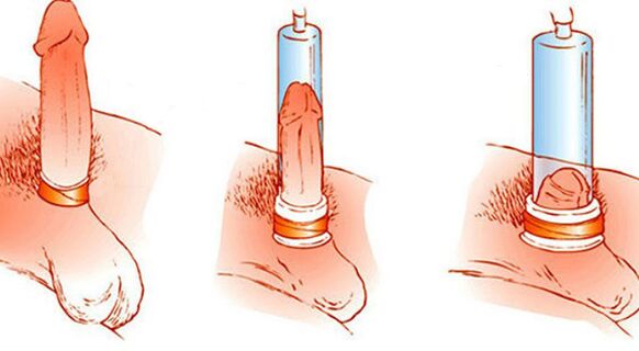 O princípio de funcionamento de uma bomba de vácuo que pode aumentar o pênis
